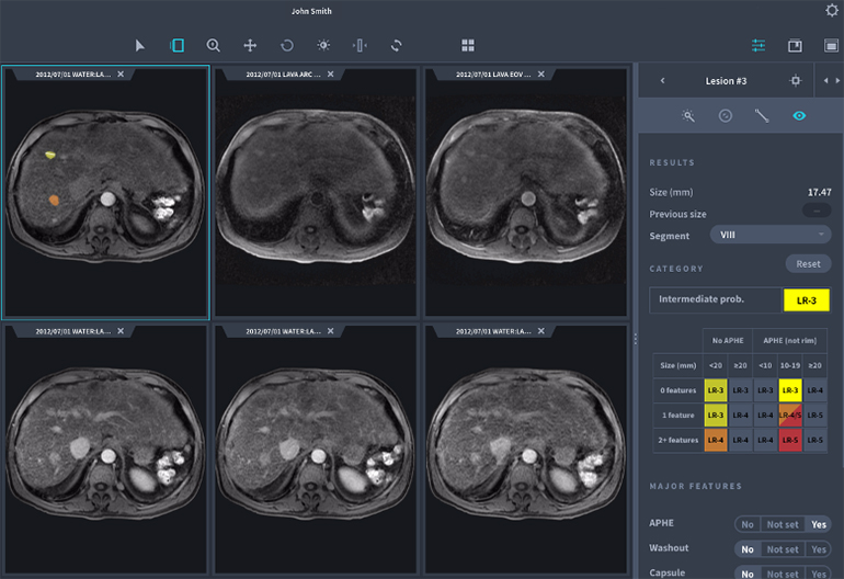 Arterys Receives FDA Clearance for Liver AI and Lung AI Lesion Spotting Software
